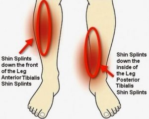 Info About Shin Splints
